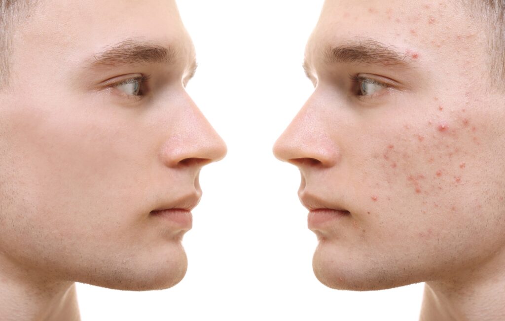 Handsome young man with problem skin on white background